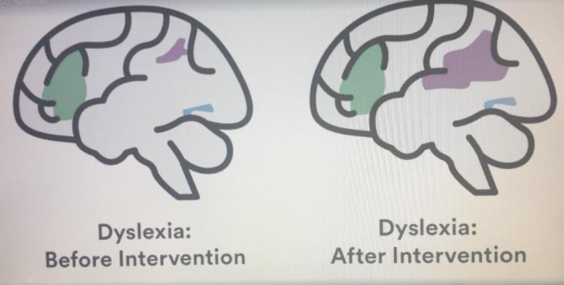 Δυσλεξία: Εγκέφαλος Πριν Και Μετά Την Παρέμβαση